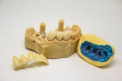 The Differences Between Dentures & Partials - Everything You Need to Know!Illustration